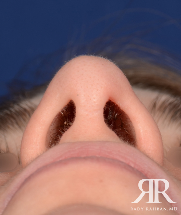 Rhinoplasty Close up