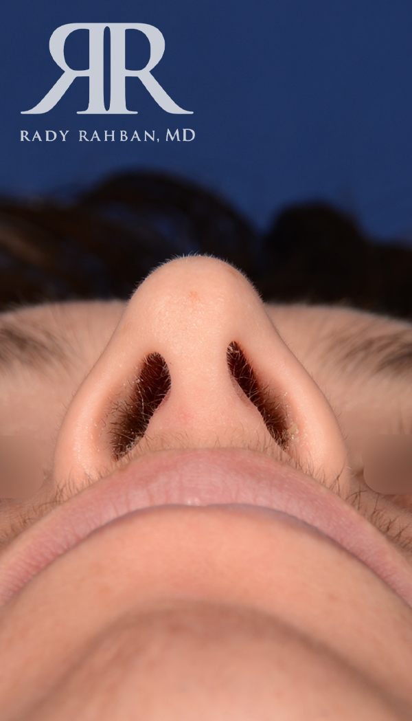 Rhinoplasty Close up