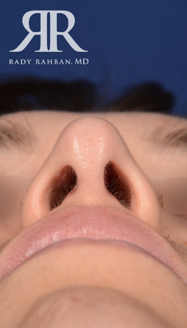 Rhinoplasty Close up