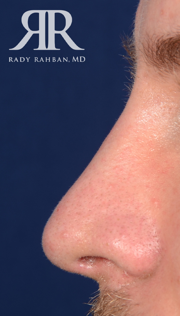 Rhinoplasty Close up