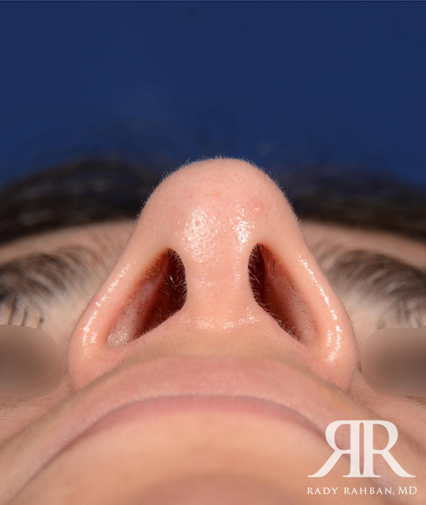 Rhinoplasty Close up