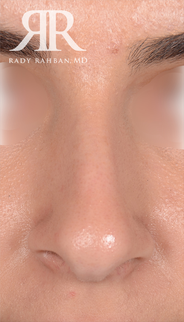 Rhinoplasty Close up