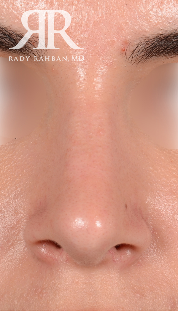 Rhinoplasty Close up