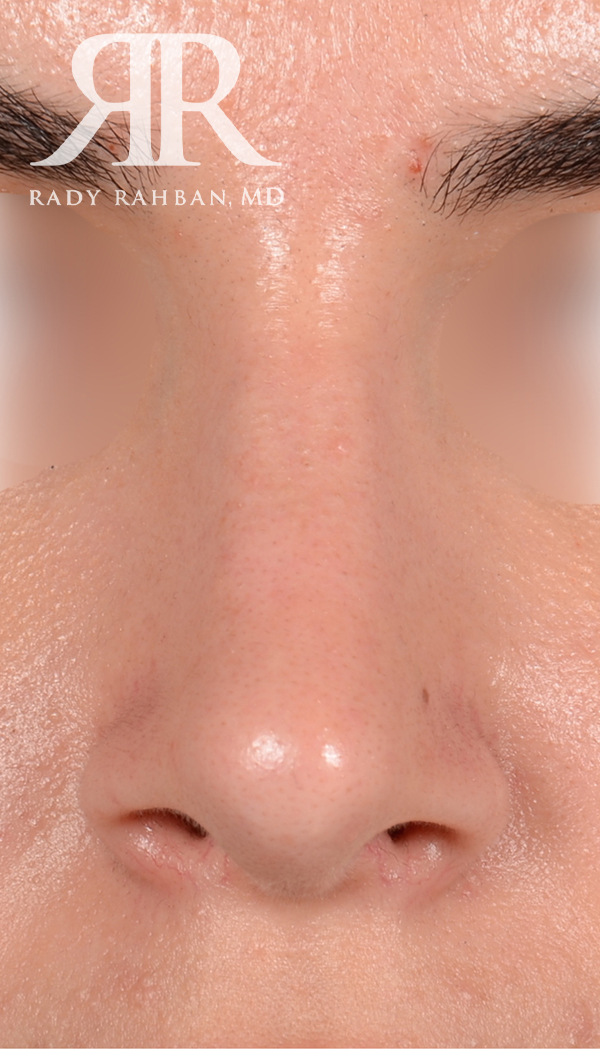 Rhinoplasty Close up