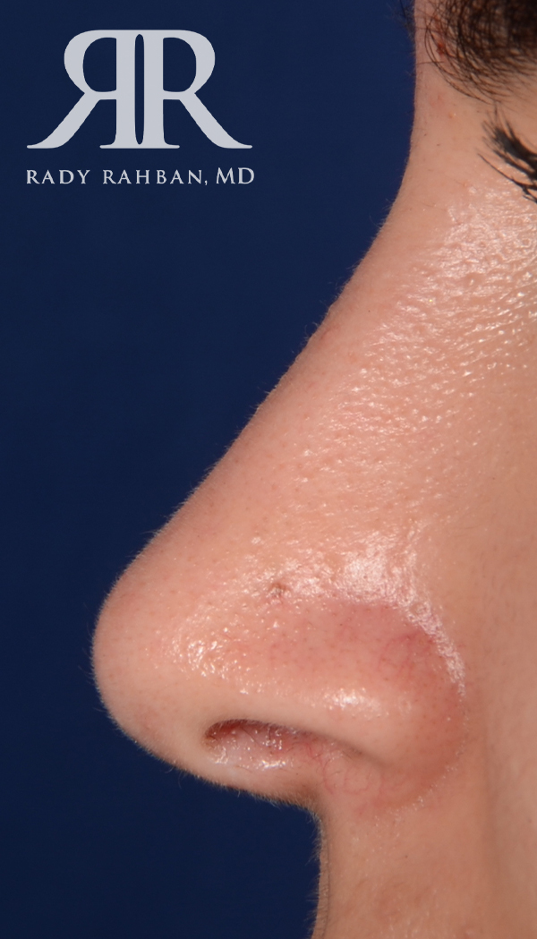 Rhinoplasty Close up