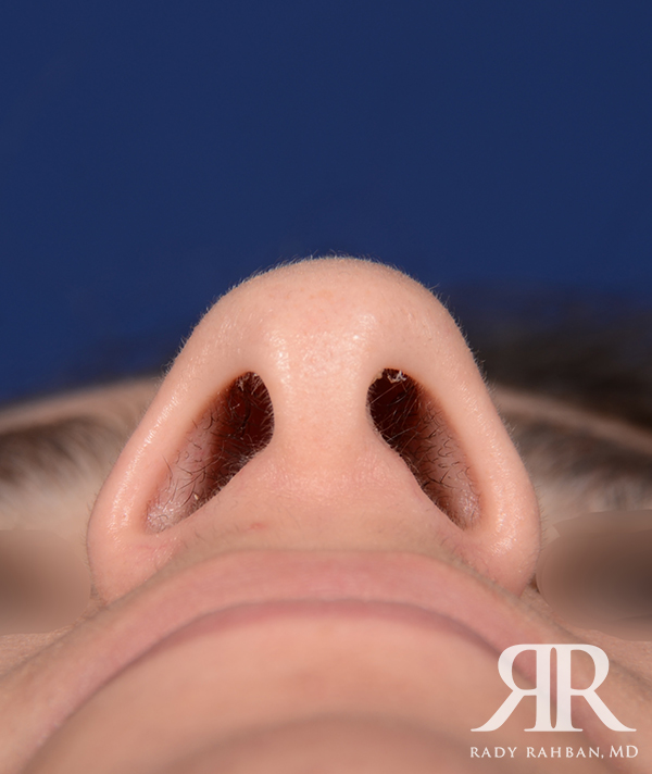 Rhinoplasty Close up