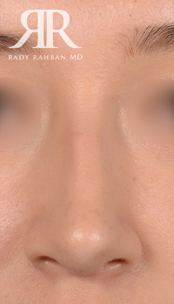 Rhinoplasty Close up