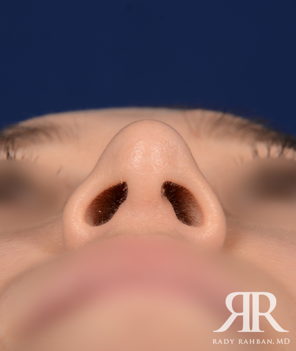 Rhinoplasty Close up