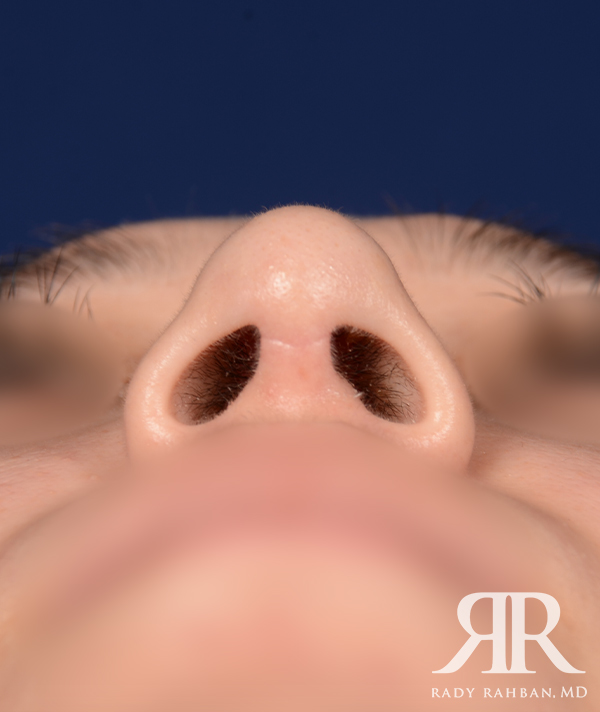 Rhinoplasty Close up