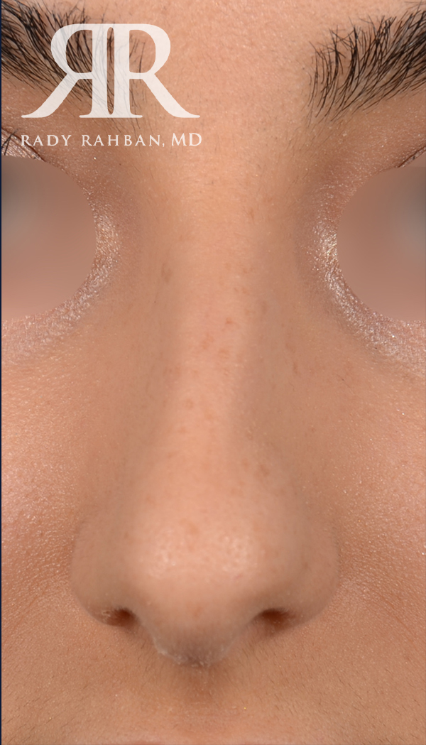 Rhinoplasty Close up