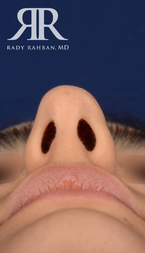 Rhinoplasty Close up