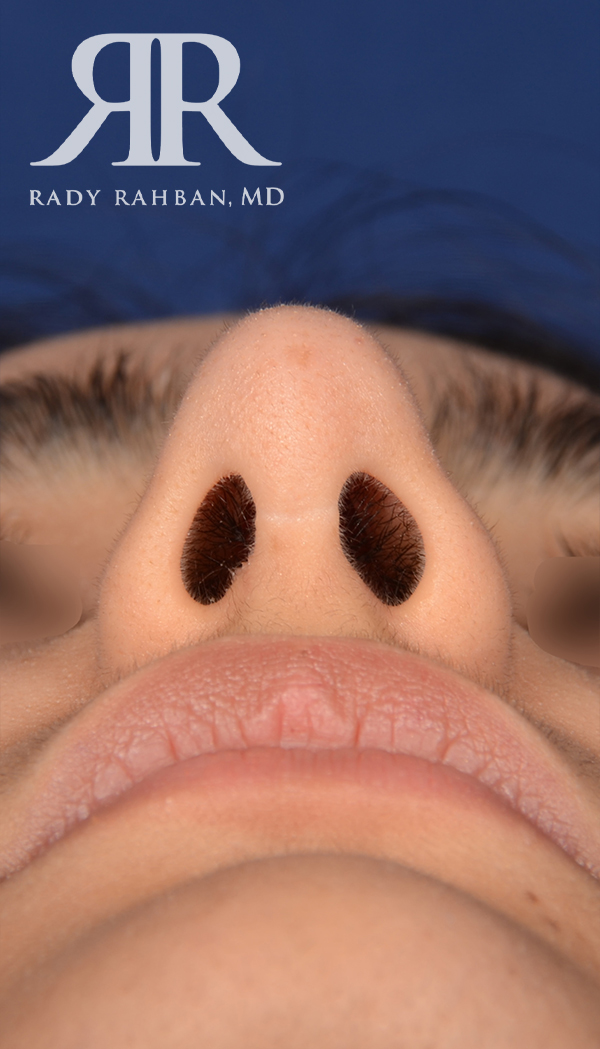 Rhinoplasty Close up