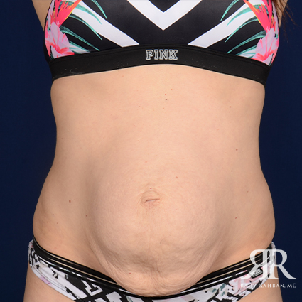 Diastasis Recti Beverly Hills