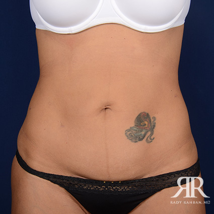 Tummy Tuck