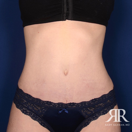 Tummy Tuck