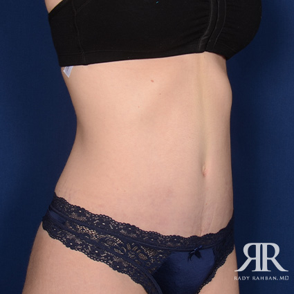 Tummy Tuck