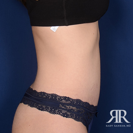 Tummy Tuck