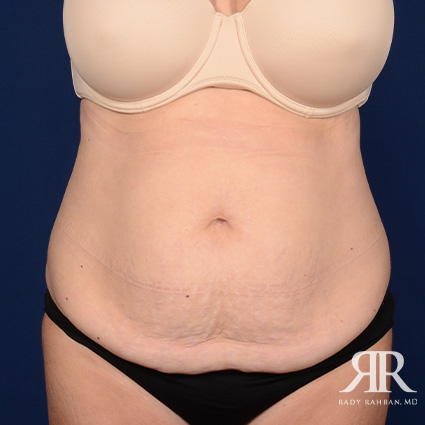 Tummy Tuck