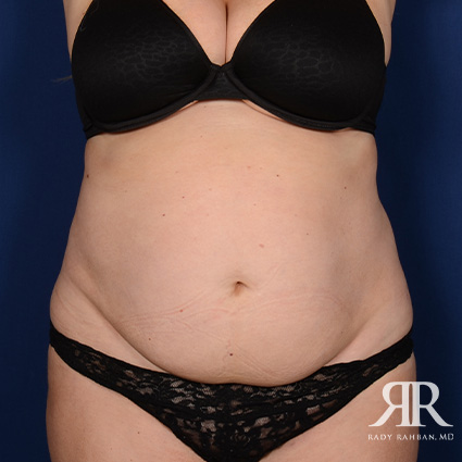 Tummy Tuck