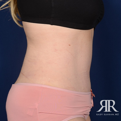 Tummy Tuck