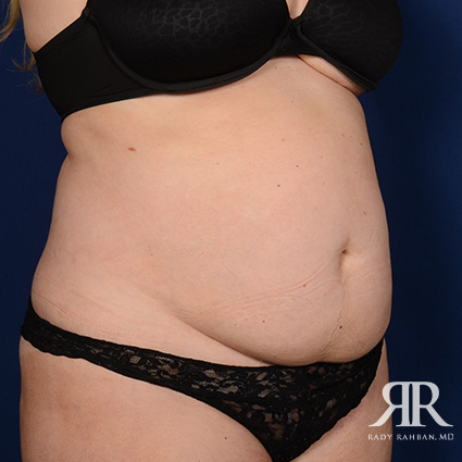 Tummy Tuck