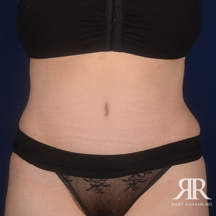 Tummy Tuck