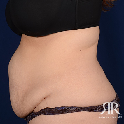 Tummy Tuck