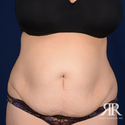Severe Diastasis Recti