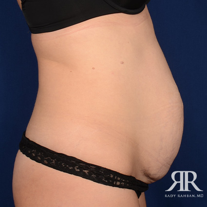 Severe Diastasis Recti