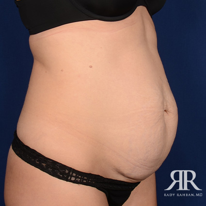 Tummy Tuck