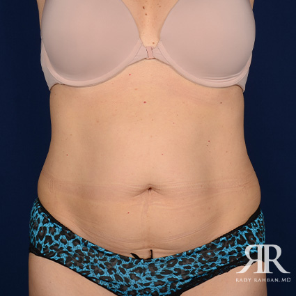 Tummy Tuck