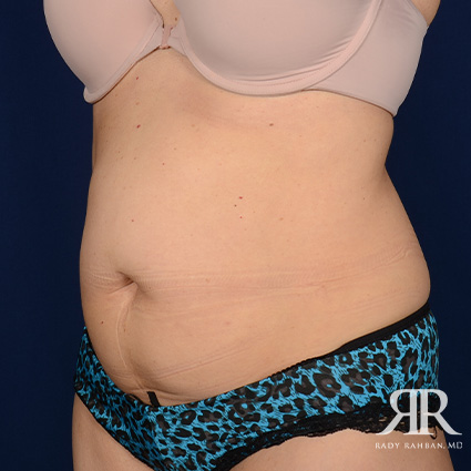 Tummy Tuck