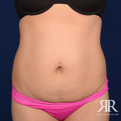 Tummy Tuck