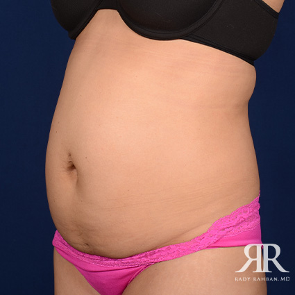 Tummy Tuck