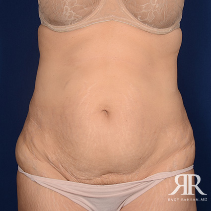 Tummy Tuck