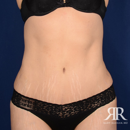 Tummy Tuck