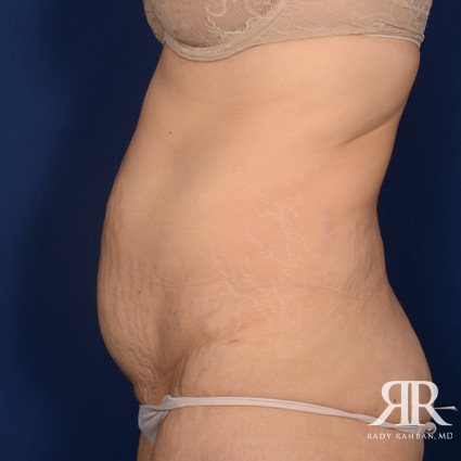 Tummy Tuck