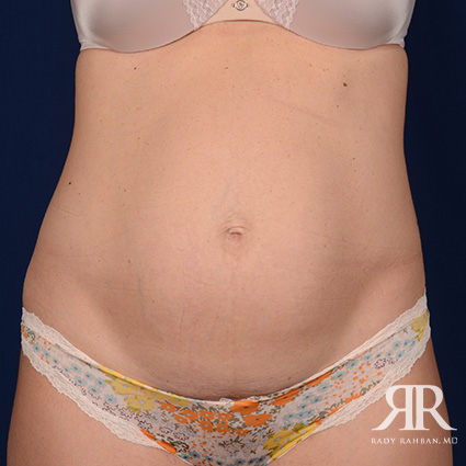 Tummy Tuck