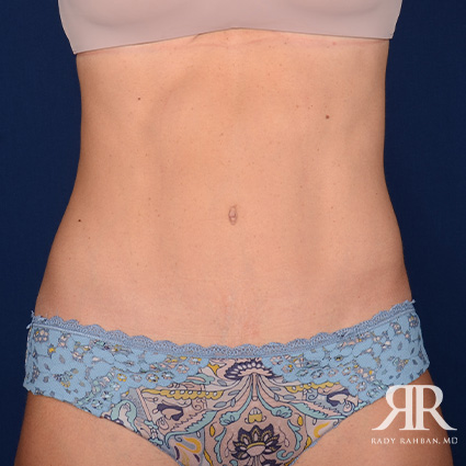 Tummy Tuck