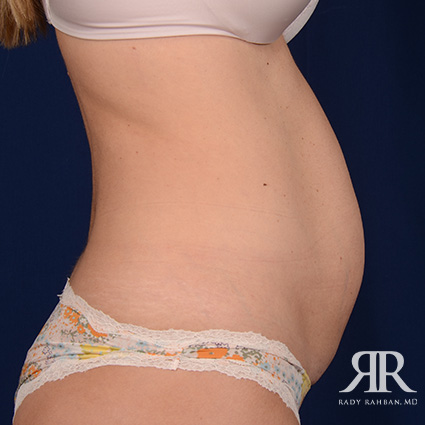 Tummy Tuck