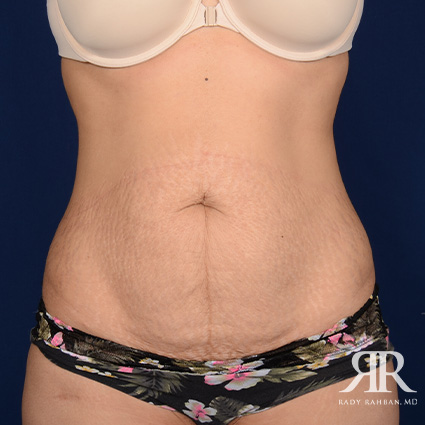 Tummy Tuck