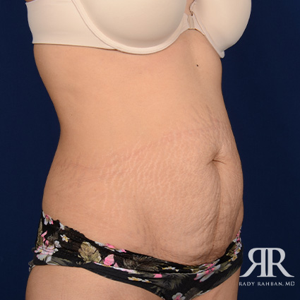 Tummy Tuck