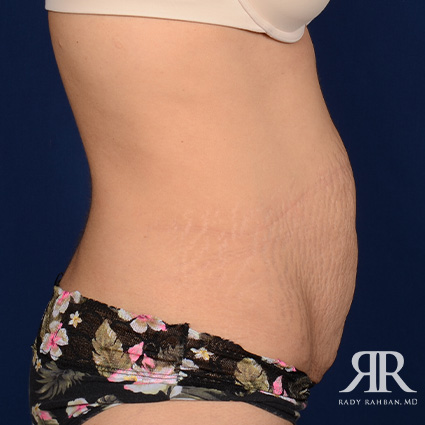 Tummy Tuck