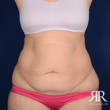 Tummy Tuck