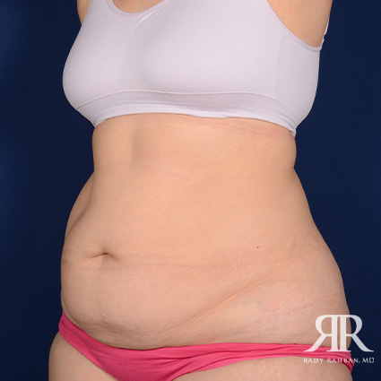 Tummy Tuck