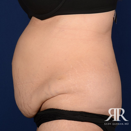 Tummy Tuck