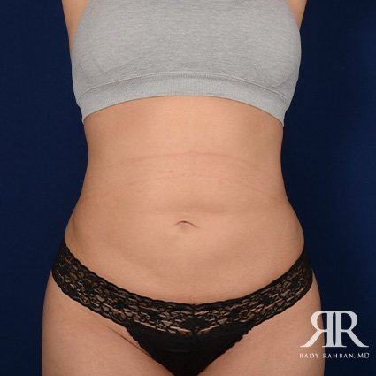 Tummy Tuck