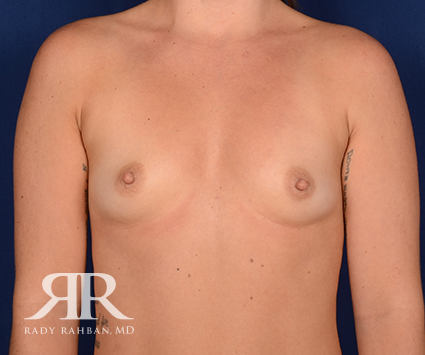 Breast Augmentation