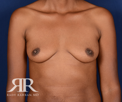 Breast Augmentation