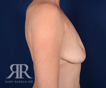 Corrective Breast Surgery